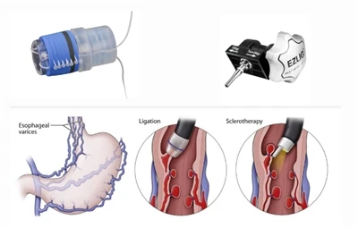 Qu'est-ce que l'EVL (ligature endoscopique des varices œsophagiennes) ?